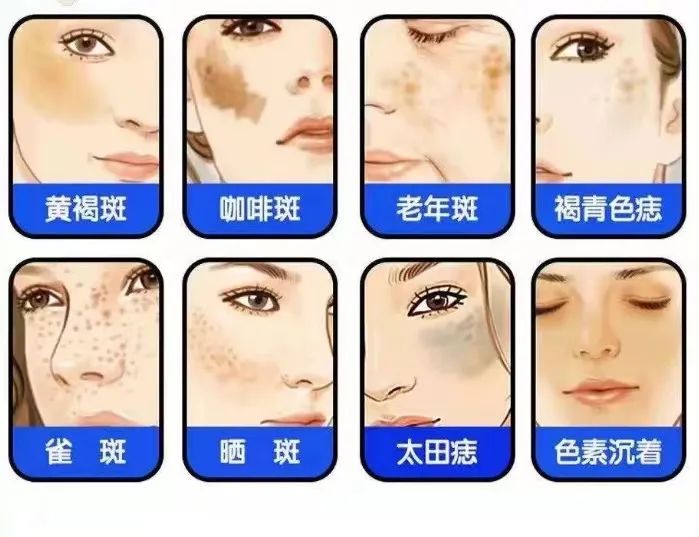 激光祛斑所有人都会反黑吗？怎么做才能不反黑？祛斑必看